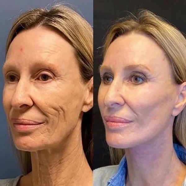 TravelTopp™ Botox Face Serum