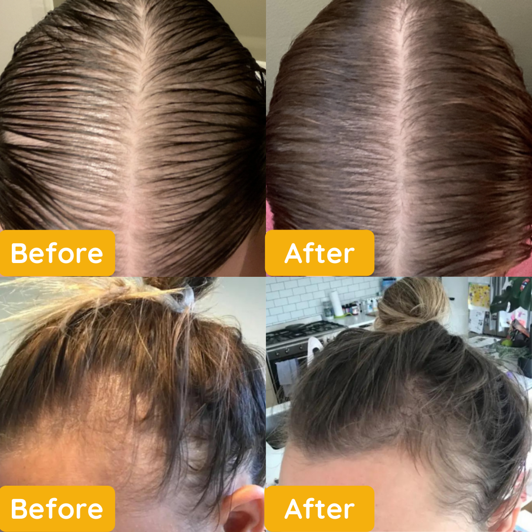 TravelTopp™ Natural Hair Growth Oil